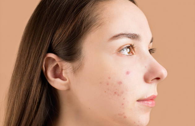 does stress cause acne