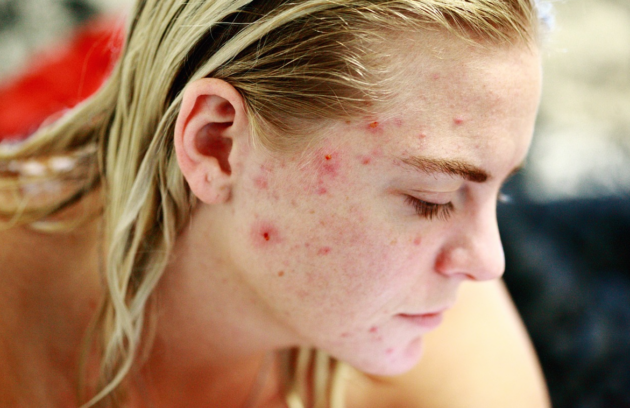 What causes hormonal acne?