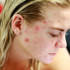 What causes hormonal acne?